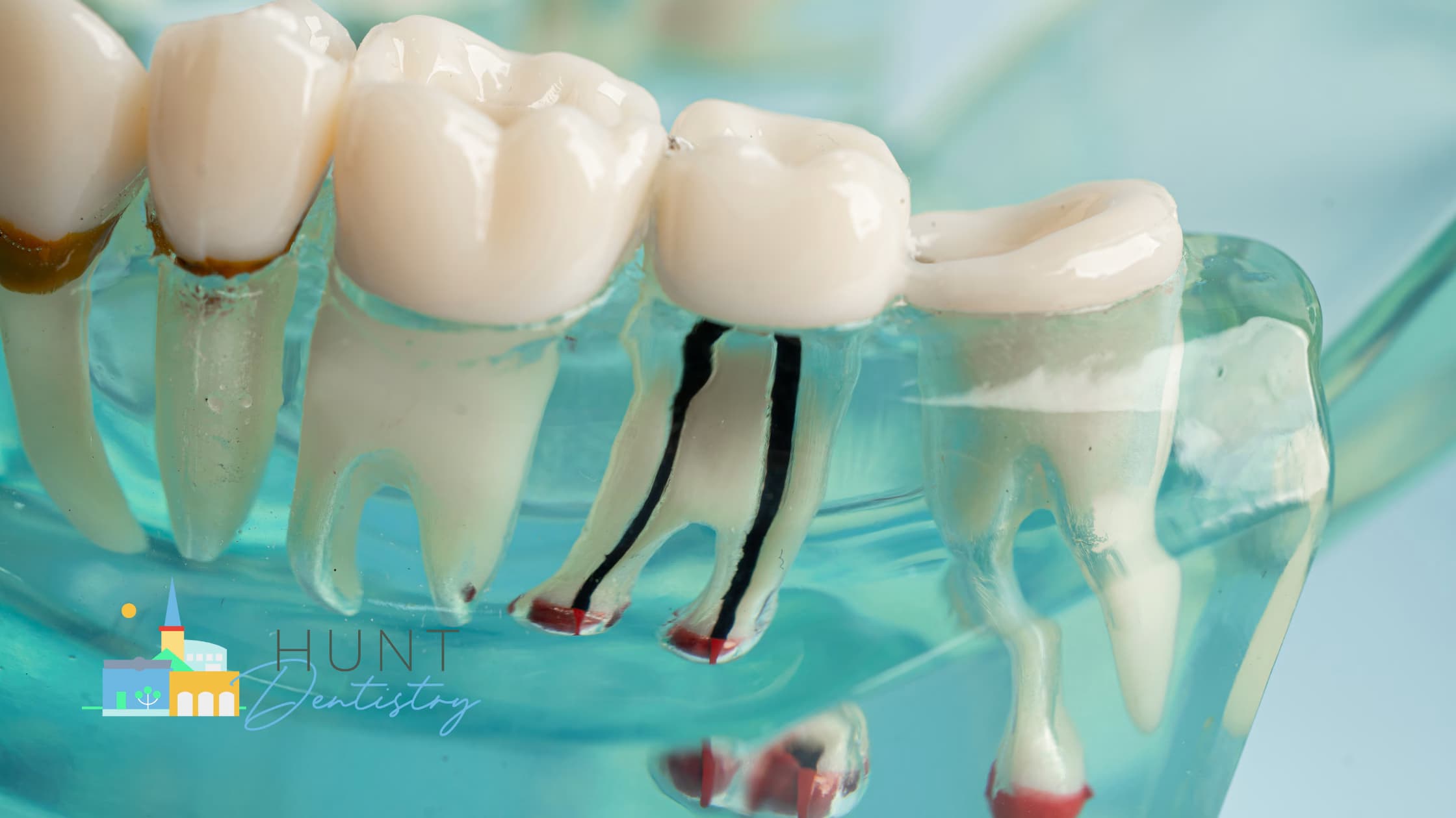 How to Know if You Need a Root Canal or Just a Filling