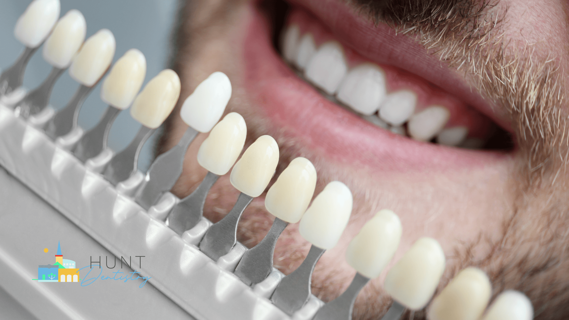 Are Veneers a Permanent Solution for Your Smile?