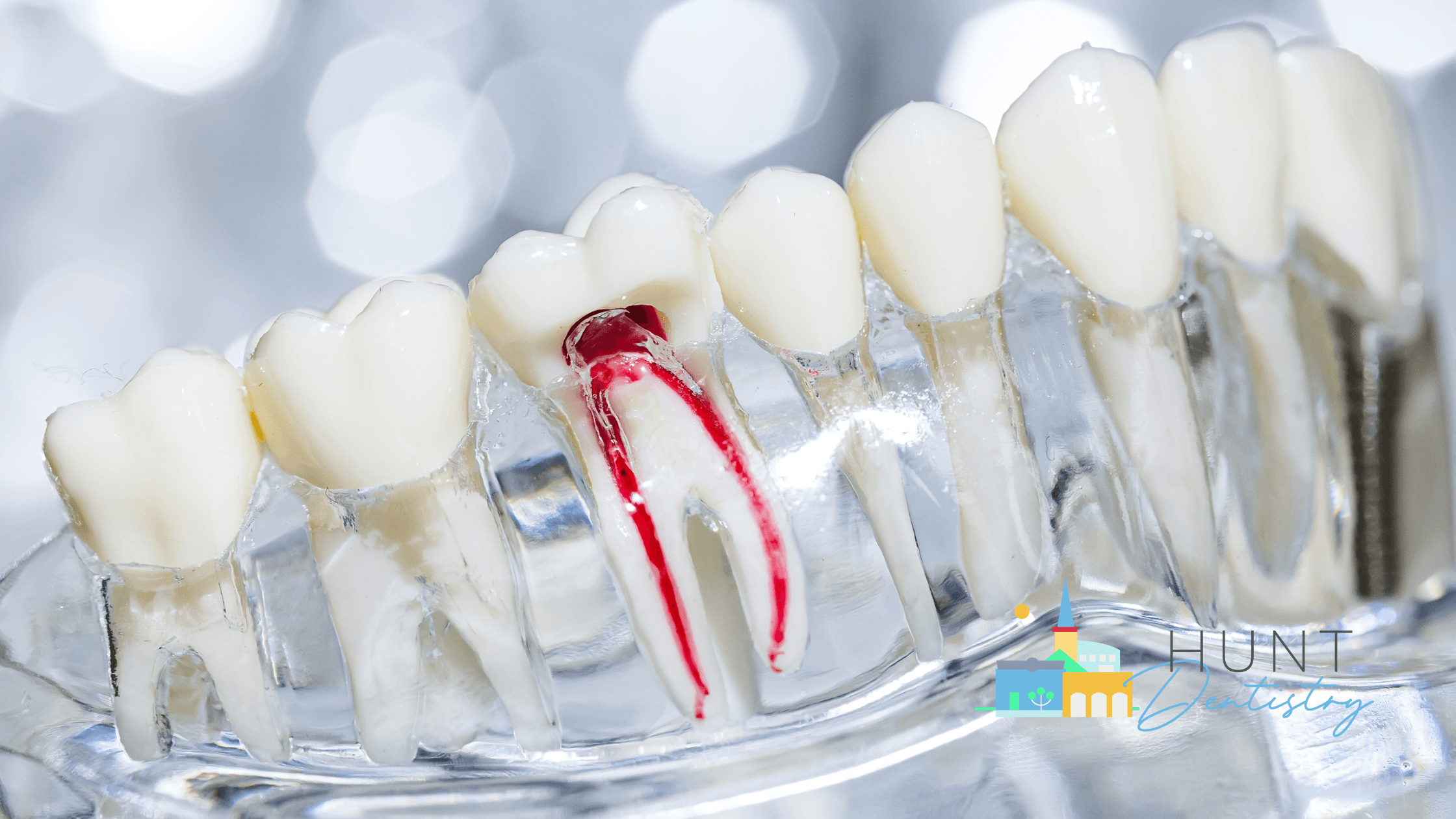 Post-Root Canal Care Tips for Longevity
